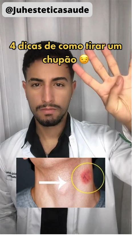 como tirar um chupao|Como tirar um Chupão: 5 dicas que ajudam rapidamente